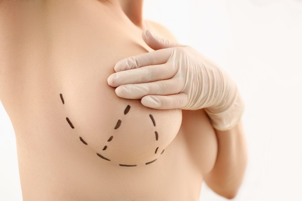 Bruststraffung – schöne Brüste nach einer Schwangerschaft